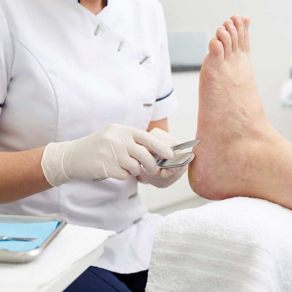 Hard skin removal in Ballymena by professional podiatrists. Safe treatment for calluses and thickene.