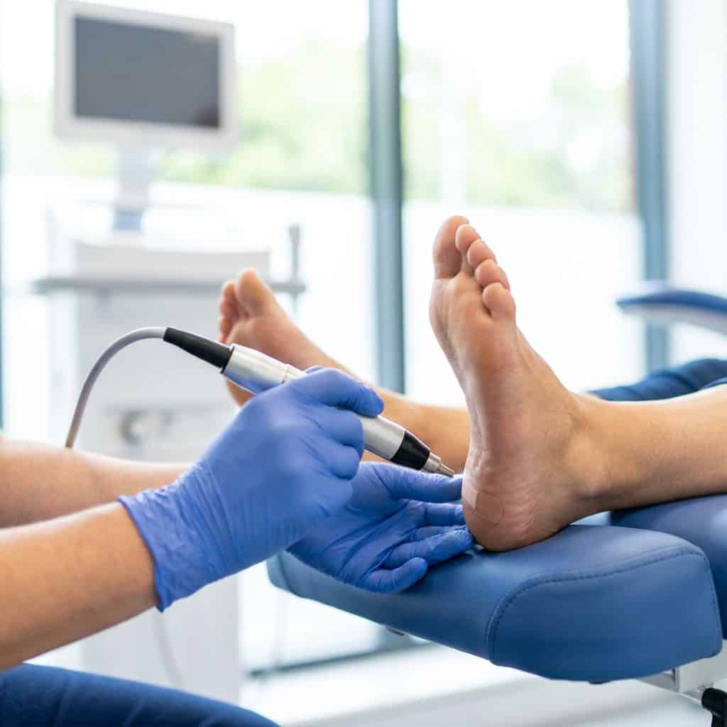 Verruca and wart removal in Ballymena
